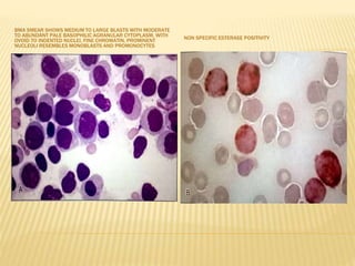 BMA SMEAR SHOWS MEDIUM TO LARGE BLASTS WITH MODERATE
TO ABUNDANT PALE BASOPHILIC AGRANULAR CYTOPLASM, WITH
OVOID TO INDENTED NUCLEI, FINE CHROMATIN, PROMINENT
NUCLEOLI RESEMBLES MONOBLASTS AND PROMONOCYTES
NON SPECIFIC ESTERASE POSITIVITY
 