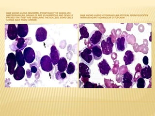BMA SHOWS LARGE ABNORMAL PROMYELOCYTES WHICH ARE
HYPERGRANULAR, GRANULES ARE SO NUMEROUS AND DENSELY
PACKED THAT THEY ARE OBSCURING THE NUCLEUS. SOME CELLS
SHOWS AUER RODS (ARROW)
BMA SHOWS LARGE HYPOGRANULAR ATYPICAL PROMYELOCYTES
WITH ABUNDANT AGRANULAR CYTOPLASM
 