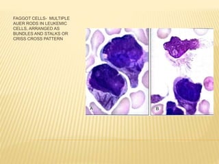 FAGGOT CELLS- MULTIPLE
AUER RODS IN LEUKEMIC
CELLS, ARRANGED AS
BUNDLES AND STALKS OR
CRISS CROSS PATTERN
 