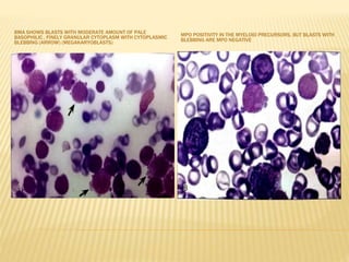 BMA SHOWS BLASTS WITH MODERATE AMOUNT OF PALE
BASOPHILIC , FINELY GRANULAR CYTOPLASM WITH CYTOPLASMIC
BLEBBING (ARROW) (MEGAKARYOBLASTS)
MPO POSITIVITY IN THE MYELOID PRECURSORS, BUT BLASTS WITH
BLEBBING ARE MPO NEGATIVE
 