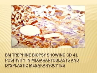 BM TREPHINE BIOPSY SHOWING CD 41
POSITIVITY IN MEGAKARYOBLASTS AND
DYSPLASTIC MEGAKARYOCYTES
 