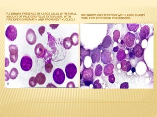 P.S SHOWS PRESENCE OF LARGE CELLS WITH SMALL
AMOUNT OF PALE GREY BLUE CYTOPLASM, WITH
FINE OPEN CHROMATIN AND PROMINENT NUCLEOLI
BM SHOWS INFILTERATION WITH LARGE BLASTS
WITH FEW ERYTHROID PRECURSORS
 