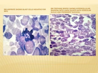 BM ASPIRATE SHOWS BLAST CELLS NEGATIVE FOR
MPO
BM TREPHINE BIOPSY SHOWS HYPERCELLULAR
MARROW WITH LARGE BLASTS WITH VESICULAR
NUCLEI AND PROMINENT NUCLEOLI
 