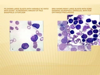 PS SHOWS LARGE BLASTS WITH VARIABLE NC RATIO
WITH SCANT TO MODERATE AMOUNT OF PALE
BASOPHILIC CYTOPLASM
BMA SHOWS MANY LARGE BLASTS WITH SOME
SHOWING AZUROPHILIC GRANULES, WITH FEW
ERYTHROID PRECURSORS
 