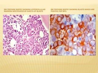 BM TREPHINE BIOPSY SHOWING HYPERCELLULAR
MARROW INFILTERATED BY SHEETS OF BLASTS
BM TREPHINE BIOPSY SHOWING BLASTS WHICH ARE
POSITIVE FOR MPO
 