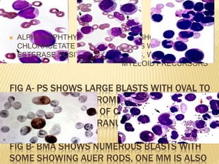 FIG A- PS SHOWS LARGE BLASTS WITH OVAL TO
INDENTED NUCLEI, PROMINENT 2 TO 3
NUCLEOLI, MOD AMT OF CYTOPLASM, WITH
FINE AZUROPHILIC GRANULES, WITH AUER
RODS(ARROW).
FIG B- BMA SHOWS NUMEROUS BLASTS WITH
SOME SHOWING AUER RODS, ONE MM IS ALSO
 ALPHA NAPHTHYL
CHLORACETATE
ESTERASE POSITIVITY
 BMA SHOWING BLAST
CELLS WITH AUER
RODS, WITH MATURING
MYELOID PRECURSORS
 