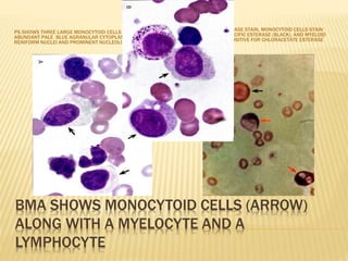 BMA SHOWS MONOCYTOID CELLS (ARROW)
ALONG WITH A MYELOCYTE AND A
LYMPHOCYTE
PS SHOWS THREE LARGE MONOCYTOID CELLS WHICH HAS
ABUNDANT PALE BLUE AGRANULAR CYTOPLASM, OVOID TO
RENIFORM NUCLEI AND PROMINENT NUCLEOLI (ARROW)
BMA WITH DUAL ESTERASE STAIN, MONOCYTOID CELLS STAIN
POSITIVE FOR NON SPECIFIC ESTERASE (BLACK), AND MYELOID
PRECURSORS STAIN POSITIVE FOR CHLORACETATE ESTERASE
(RED)
 