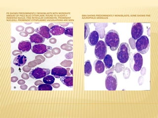PS SHOWS PREDOMINENTLY MONOBLASTS WITH MODERATE
AMOUNT OF PALE BLUE CYTOPLASM, ROUND TO SLIGHTLY
INDENTED NUCLEI, FINE RETICULAR CHROMATIN, PROMINENT
NUCLEOLI. PROMINENT CYTOPLASMIC VACUOLATIONS ARE SEEN
BMA SHOWS PREDOMINENTLY MONOBLASTS, SOME SHOWS FINE
AZUROPHILIC GRANULES
 