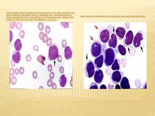 PS SHOWS LARGE NUMBER OF PROMONOCYTES AND MONOCYTES
WITH ARROW SHOWING SINGLE MONOBLAST. PROMONOCYTES
HAVE ABUNDANT PALE BASOPHILIC CYTOPLASM AND IRREGULAR
CONVOLUTED NUCLEI AND PROMINENT NUCLEOLI
BMA SHOWS PROMONOCYTES (BLACK) AND MONOBLAST (RED)
 