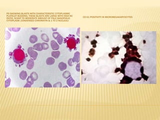 PS SHOWING BLASTS WITH CHARACTERISTIC CYTOPLASMIC
PLATELET BUDDING, THESE BLASTS ARE LARGE WITH HIGH NC
RATIO, SCANT TO MODERATE AMOUNT OF PALE BASOPHILIC
CYTOPLASM ,CONDENSED CHROMATIN & 1 TO 2 NUCLEOLI
CD 61 POSITIVITY IN MICROMEGAKARYOCYTES
 