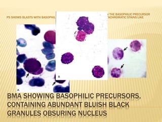 BMA SHOWING BASOPHILIC PRECURSORS,
CONTAINING ABUNDANT BLUISH BLACK
GRANULES OBSURING NUCLEUS
PS SHOWS BLASTS WITH BASOPHILIC GRANULES
THE GRANULES IN THE BASOPHILIC PRECURSOR
STAINS WITH METACHROMATIC STAINS LIKE
TOLUIDINE BLUE
 