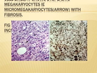 CELL LINES, IT SHOWS DYSPLASTIC
MEGAKARYOCYTES IE
MICROMEGAKARYOCYTES(ARROW) WITH
FIBROSIS.
FIG 2 SHOWS RETICULIN STAIN SHOWS
INCREASE IN RETICULIN FIBRES
 