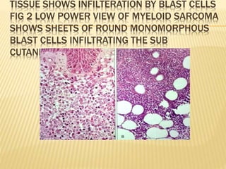 TISSUE SHOWS INFILTERATION BY BLAST CELLS
FIG 2 LOW POWER VIEW OF MYELOID SARCOMA
SHOWS SHEETS OF ROUND MONOMORPHOUS
BLAST CELLS INFILTRATING THE SUB
CUTANEOUS TISSUE
 