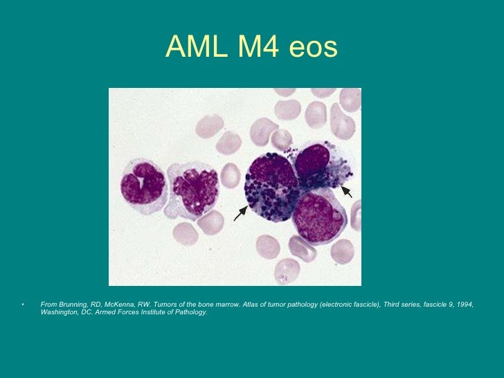 M4 M5 Aml : AML types: Classification and identification – CEMVJ