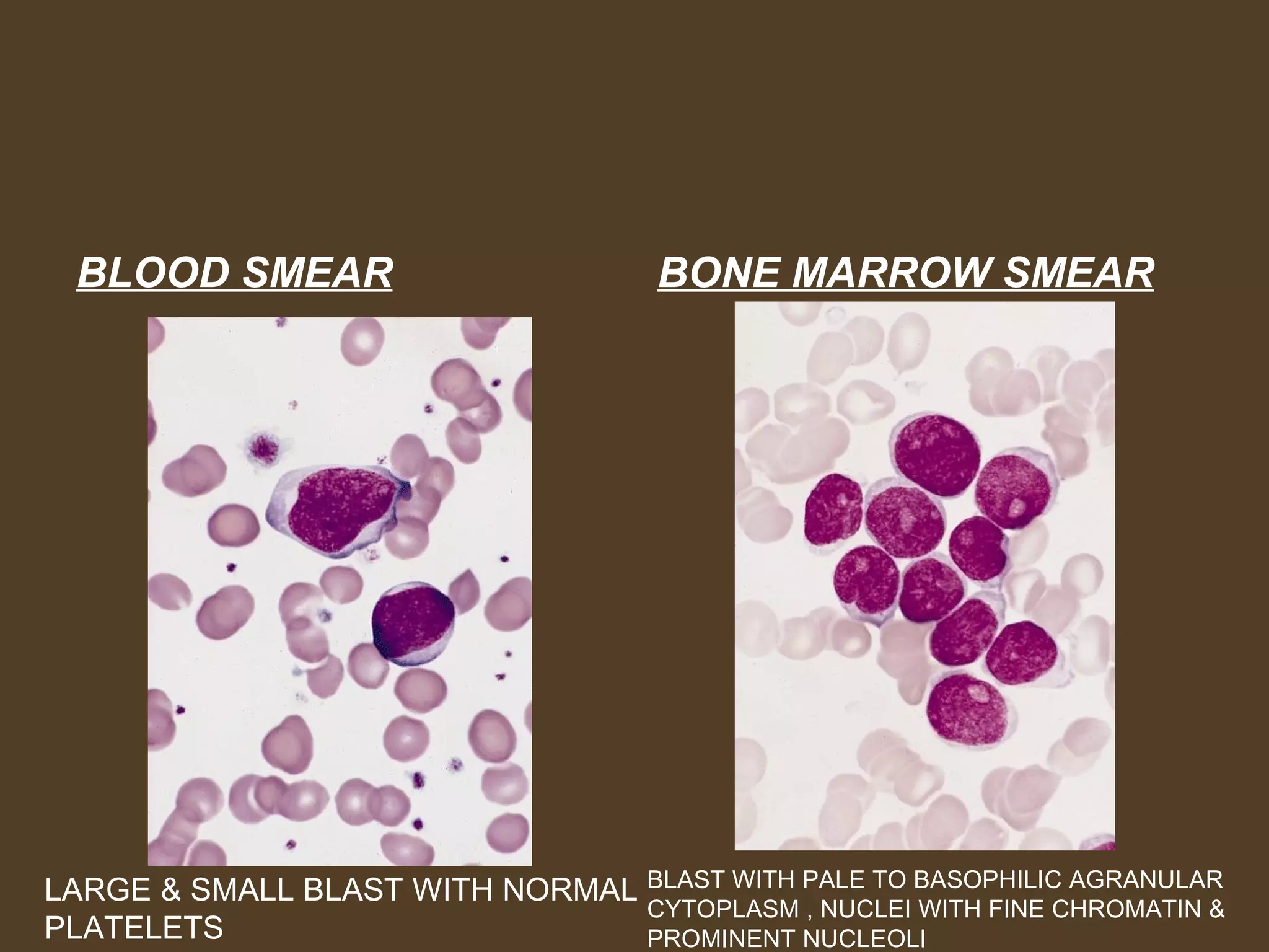 Acute myeloid leukemia | PPT