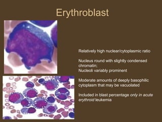 Erythroblast 
Relatively high nuclear/cytoplasmic ratio 
Nucleus round with slightly condensed 
chromatin; 
Nucleoli variably prominent 
Moderate amounts of deeply basophilic 
cytoplasm that may be vacuolated 
Included in blast percentage only in acute 
erythroid leukemia 
 
