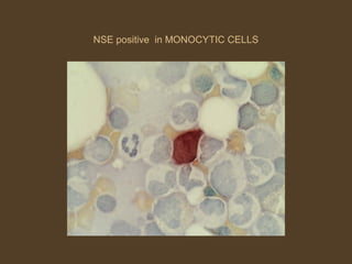 NSE positive in MONOCYTIC CELLS 
 