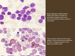 Morphologically undifferentiated 
blasts with distinct nucleoli are 
peroxidase-negative and do not 
show the esterase reaction typical of 
monocytes 
Bone marrow smear from the same 
patient. Immunocytochemical detection 
of CD13. A large proportion of the 
blasts are positive (red). 
 