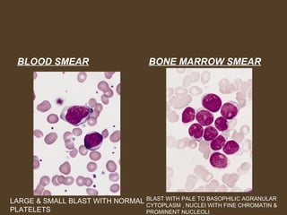BLOOD SMEAR BONE MARROW SMEAR 
LARGE & SMALL BLAST WITH NORMAL 
PLATELETS 
BLAST WITH PALE TO BASOPHILIC AGRANULAR 
CYTOPLASM , NUCLEI WITH FINE CHROMATIN & 
PROMINENT NUCLEOLI 
 