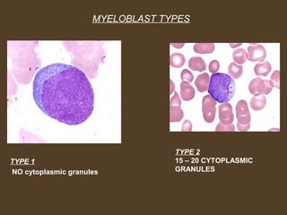 MYELOBLAST TYPES 
TYPE 1 
NO cytoplasmic granules 
TYPE 2 
15 – 20 CYTOPLASMIC 
GRANULES 
 