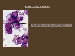 BONE MARROW SMEAR 
BLAST WITH NUCLEOLI AUER RODS 
 