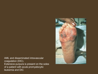 AML and disseminated intravascular 
coagulation (DIC). 
Extensive purpura is present on the soles 
of a patient with acute promyelocytic 
leukemia and DIC 
 