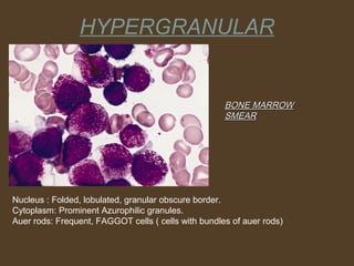 HYPERGRANULAR 
BBOONNEE MMAARRRROOWW 
SSMMEEAARR 
Nucleus : Folded, lobulated, granular obscure border. 
Cytoplasm: Prominent Azurophilic granules. 
Auer rods: Frequent, FAGGOT cells ( cells with bundles of auer rods) 
 
