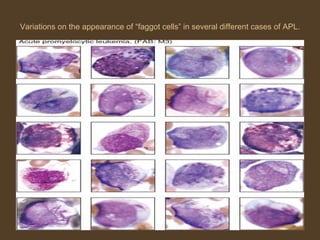 Variations on the appearance of “faggot cells” in several different cases of APL. 
 