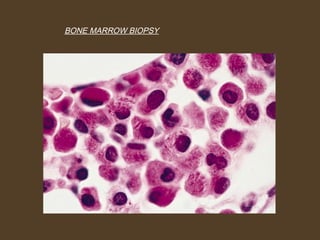 BONE MARROW BIOPSY 
 