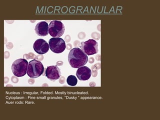 MICROGRANULAR 
Nucleus : Irregular, Folded. Mostly binucleated. 
Cytoplasm : Fine small granules, “Dusky “ appearance. 
Auer rods: Rare. 
 