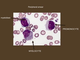 Peripheral smear 
myeloblast 
MYELOCYTE 
PROMONOCYTE 
 