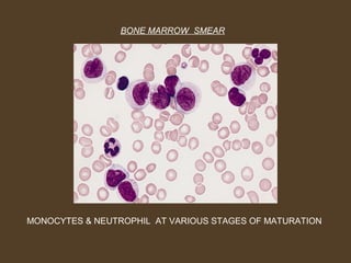 BONE MARROW SMEAR 
MONOCYTES & NEUTROPHIL AT VARIOUS STAGES OF MATURATION 
 