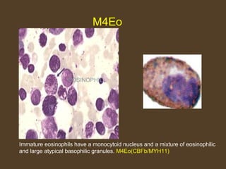 M4Eo 
EOSINOPHIL 
Immature eosinophils have a monocytoid nucleus and a mixture of eosinophilic 
and large atypical basophilic granules. M4Eo(CBFb/MYH11) 
 