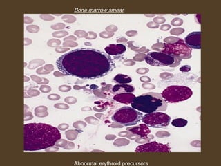 Bone marrow smear 
Abnormal erythroid precursors 
 
