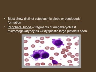 • Blast show distinct cytoplasmic blebs or psedopods 
formation 
• Peripheral blood – fragments of megakaryoblast 
micromegakaryocytes Or dysplastic large platelets seen 
 