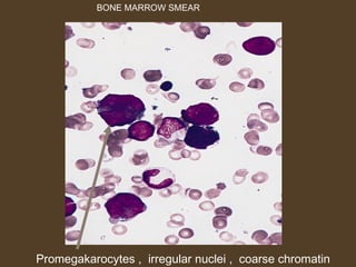 BONE MARROW SMEAR 
Promegakarocytes , irregular nuclei , coarse chromatin 
 