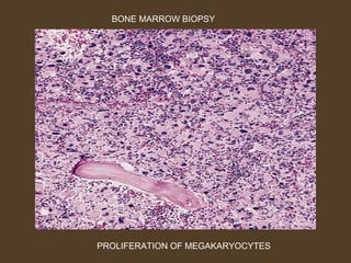 BONE MARROW BIOPSY 
PROLIFERATION OF MEGAKARYOCYTES 
 