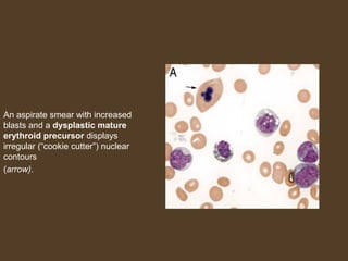 An aspirate smear with increased 
blasts and a dysplastic mature 
erythroid precursor displays 
irregular (“cookie cutter”) nuclear 
contours 
(arrow). 
 