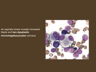 An aspirate smear reveals increased 
blasts and two dysplastic 
micromegakaryocytes (arrows). 
 