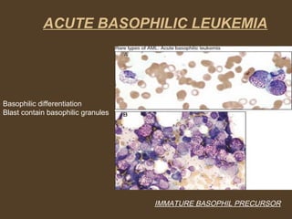 ACUTE BASOPHILIC LEUKEMIA 
IMMATURE BASOPHIL PRECURSOR 
Basophilic differentiation 
Blast contain basophilic granules 
 