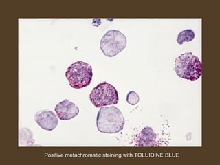 Positive metachromatic staining with TOLUIDINE BLUE 
 