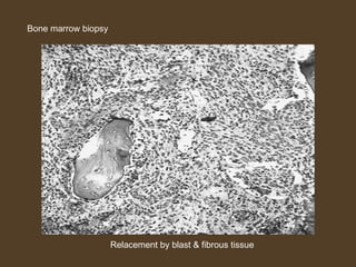 Relacement by blast & fibrous tissue 
Bone marrow biopsy 
 