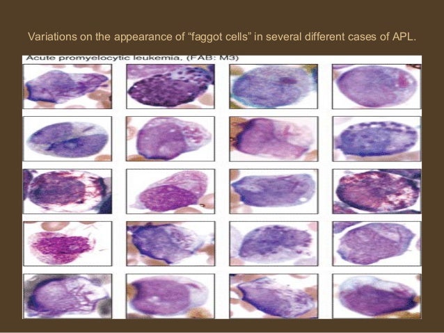 Acute Myeloid Leukemia