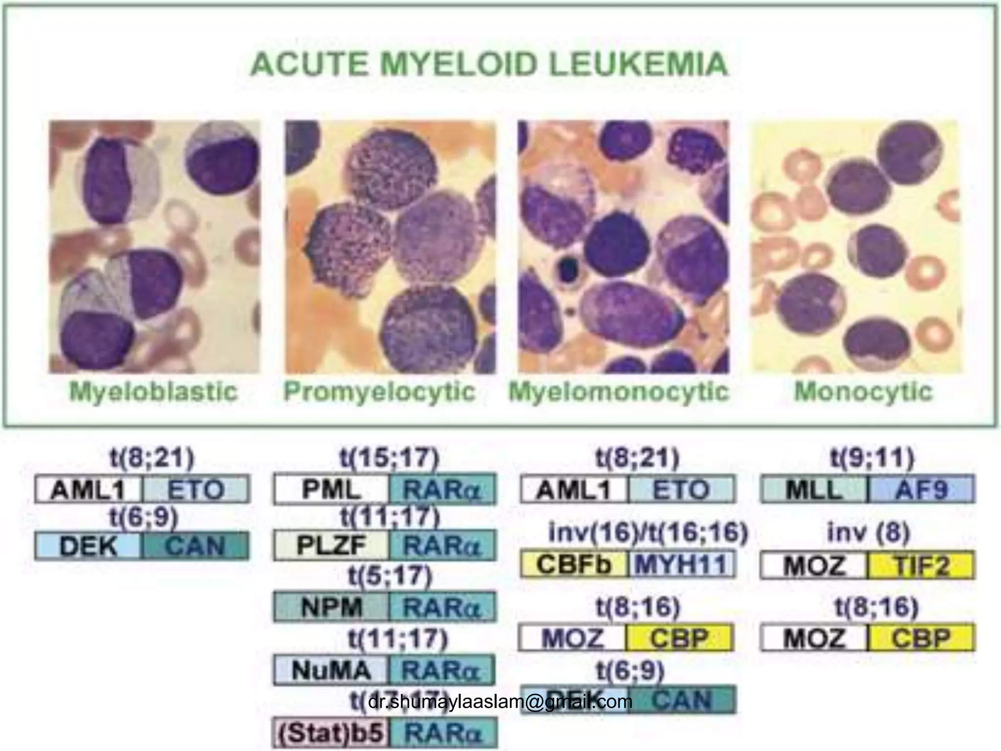 Acute myeloid leukemia | PPTX