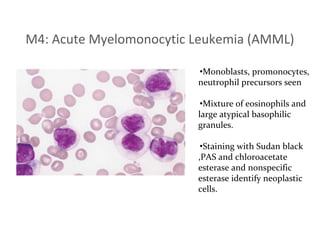 Acute myeloid leukemia | PDF