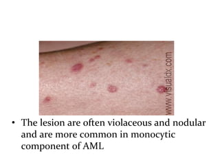 Acute myeloid leukemia | PDF