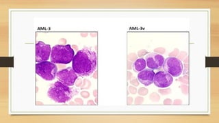 ACUTE MYELOID LEUKEMIA PPT .presentstion | PPTX
