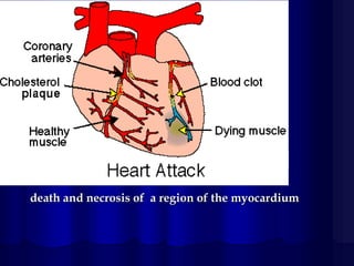 Infarctus Rouge Acute myocardial infarction | PDF