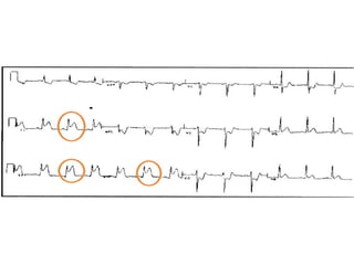 Atrial Infarction Acute myocardial infarction | PPT
