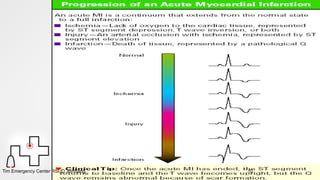 Opercular Acute Infarct Acute Myocardial Infarction Infarction.pptx